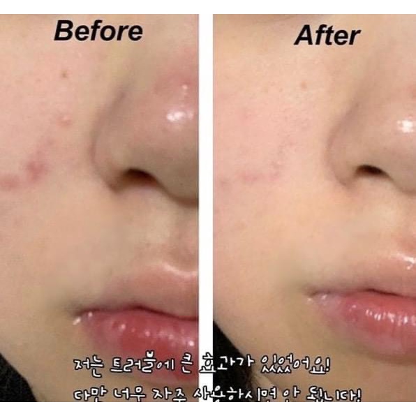 [Auth]- Bông tẩm BHA 0.5%-2% Stridex- Hỗ trợ giảm mụn, peel da, sạch da