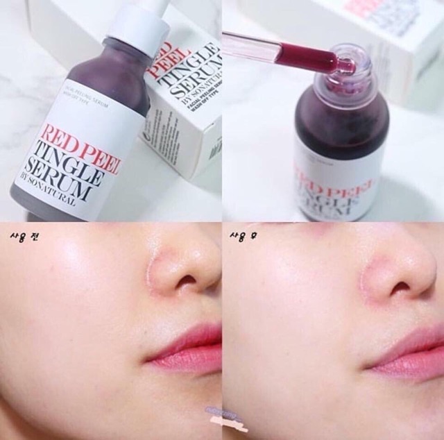 Phương pháp thay da thế hệ mới Redpeel TINGLE SERUM