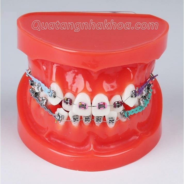 Mô hình mẫu hàm tư vấn chỉnh nha/ niềng năng đầy đủ mắc cài, dây cung, khí cụ - Mô hình răng nha khoa