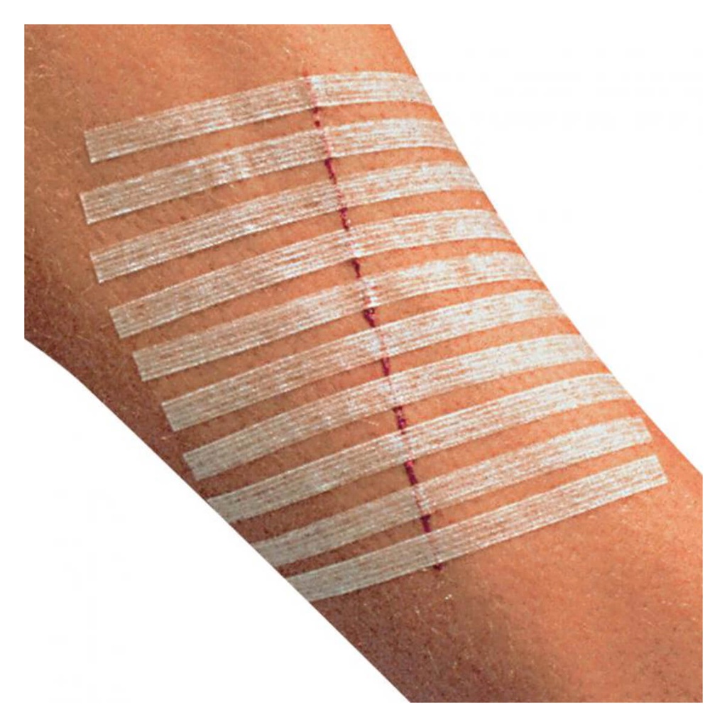Adhesive Skin Closure - Băng dính dán da Steri Strip thay thế chỉ khâu da 3M Steri Strip trong phẫu thuật tránh giãn sẹo