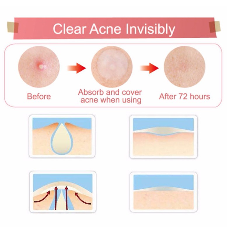 Miếng Dán Mụn, Che Phủ Nốt Mụn COSRX Acne Pimple Master Patch (Gồm 24 miếng dán)