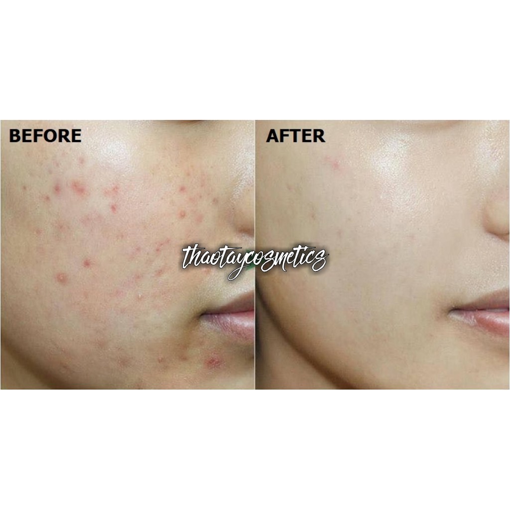 [Hàng Mỹ] Sữa rửa mặt làm giảm mụn Neutrogena Oil-Free Acne Wash (177ml) | BigBuy360 - bigbuy360.vn