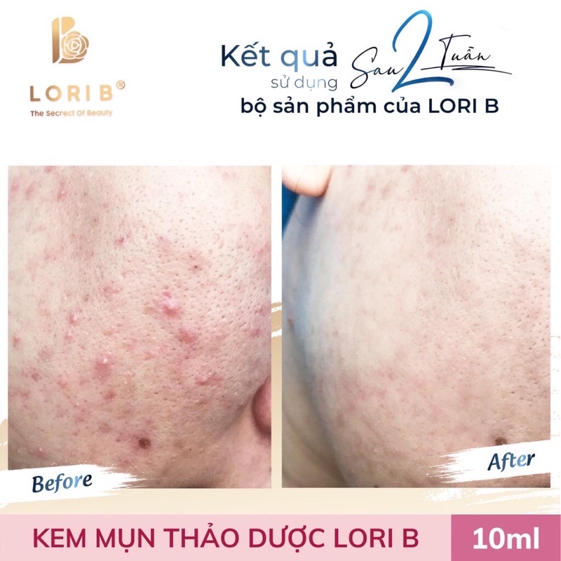 Kem mụn LoriB