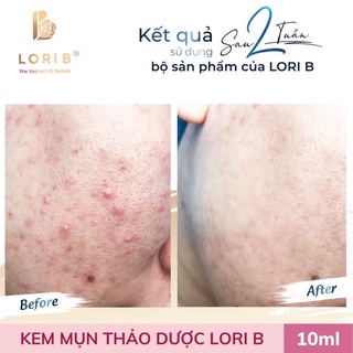 kem mụn LoriB [hàng chính hãng công ty] Date mới