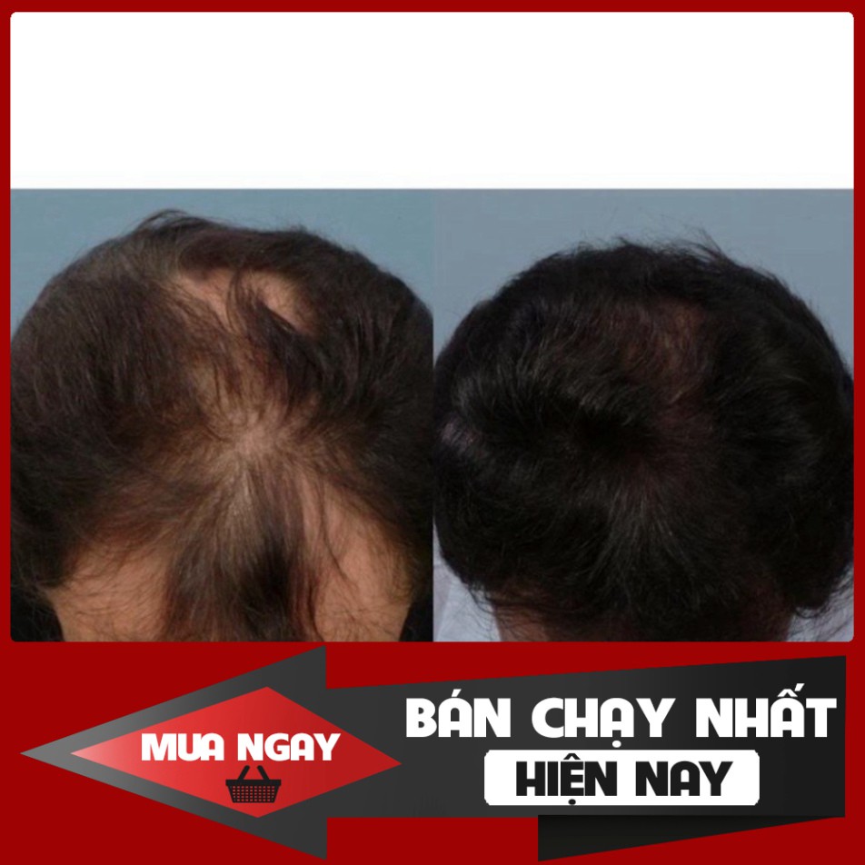 BÁN CHẠY NHẤT Viên uống hỗ trợ mọc tóc Biotin 10,000mcg - Dùng kèm Minoxidil BÁN CHẠY NHẤT