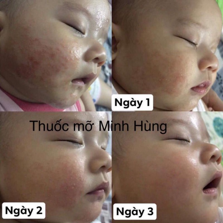 Kem mỡ, kem bôi da Minh Hùng