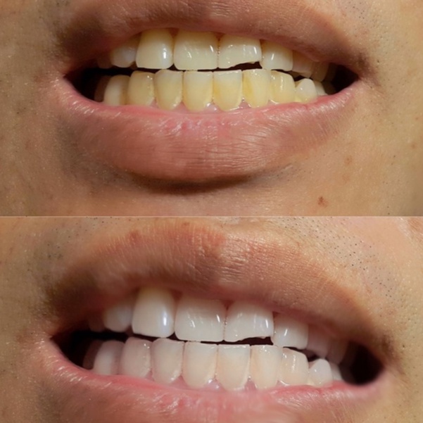 [Full COMBO Quà + Sale 30%] Smilee Max, Smilee Extra - Bộ kit tẩy trắng răng, làm trắng răng không ê buốt - Xuất xứ USA
