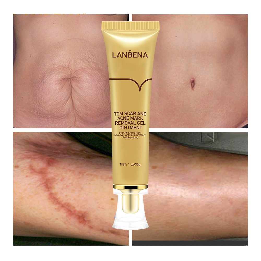 Set 2 Mỹ Phẩm Chăm Sóc Da LANBENA Gồm Serum Xóa Sẹo Mụn+Kem Làm Trắng Mụn Đầu Đen Thu Nhỏ Lỗ Chân Lông Làm Mờ Vết Rạn Da | BigBuy360 - bigbuy360.vn