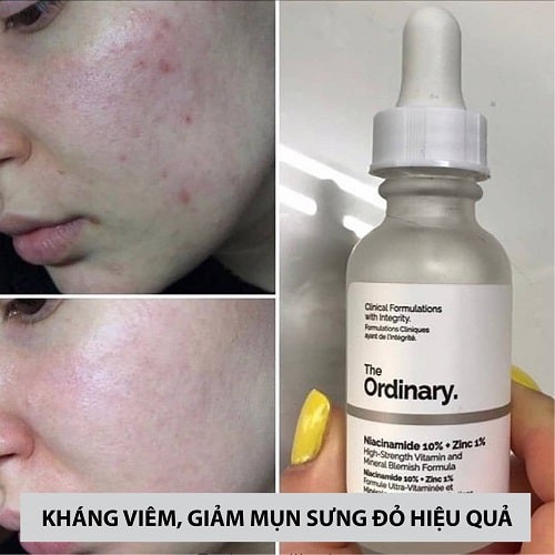 Serum The Ordinary Niacinamide 10% + Zinc 1% – Serum Chống Viêm, Giảm Kích Ứng Dành Cho Da Mụn | BigBuy360 - bigbuy360.vn