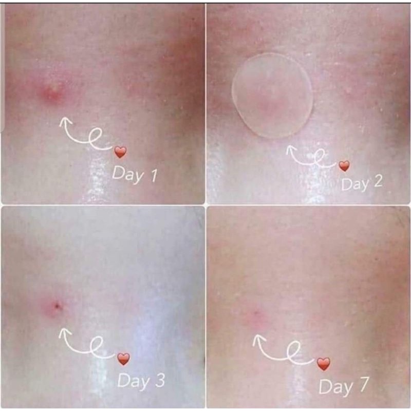 Miếng dán mụn Hàn quốc | BigBuy360 - bigbuy360.vn