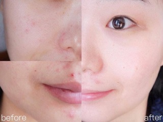 Lotion bye bye blemish