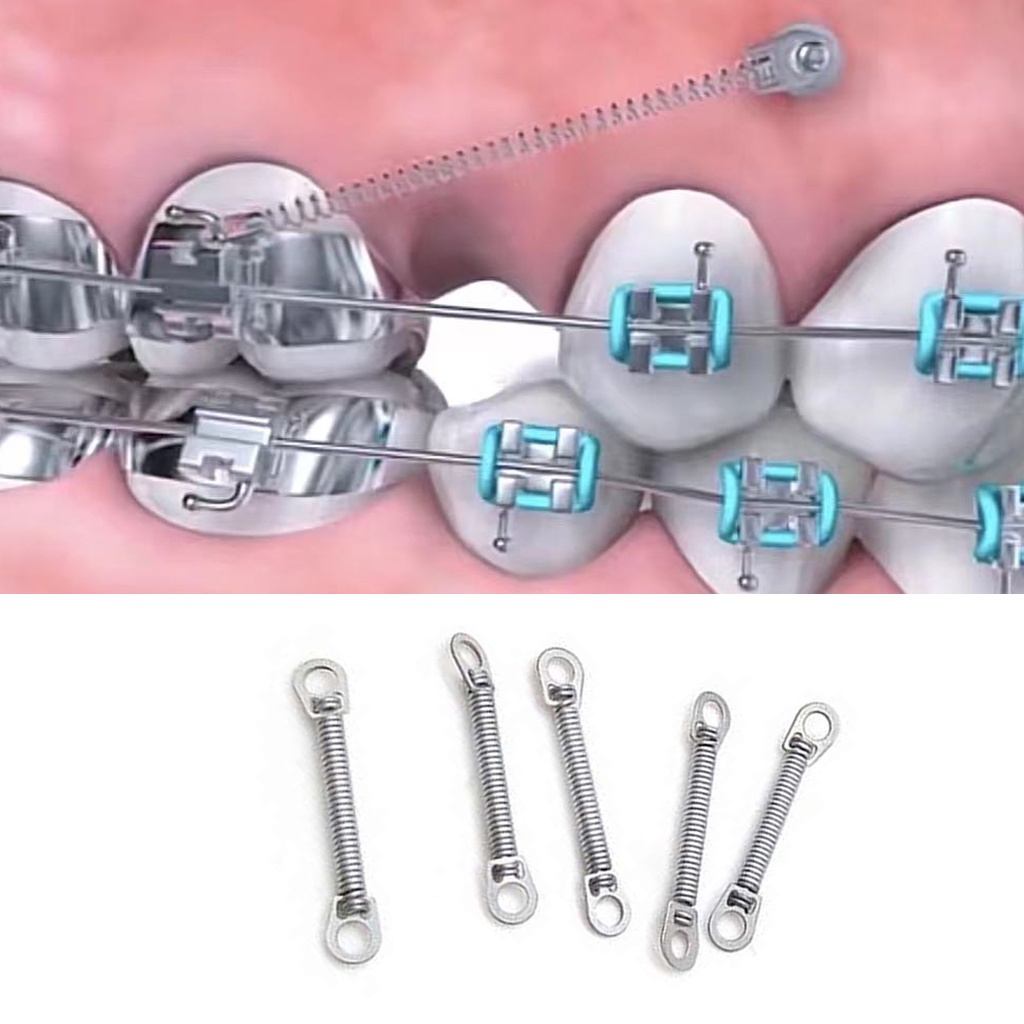 Lò xo đóng khoảng nha khoa,vật liệu chỉnh nha lò xo kéo