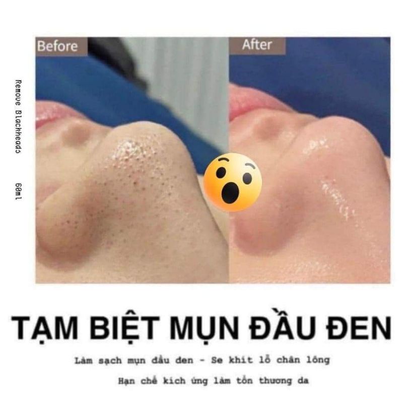 Ủ Mũi Xử Lý Mụn đầu đen Removes Blackheads 60ml