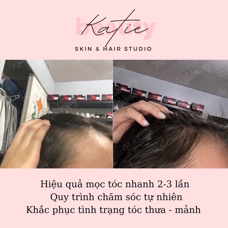 Dầu Ủ SIÊU KÍCH MỌC TÓC HỖ TRỢ PHỤC HỒI DA ĐẦU DẦU BẾT - Rosemary Oil For Hair Growth 100ml | KATIEBEAUTY