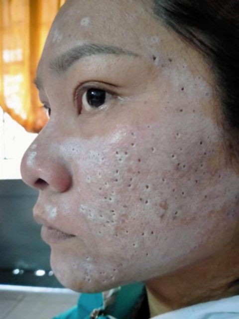 SÉT NHỎ PEEL TCA USA