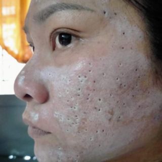 SÉT NHỎ PEEL TCA USA