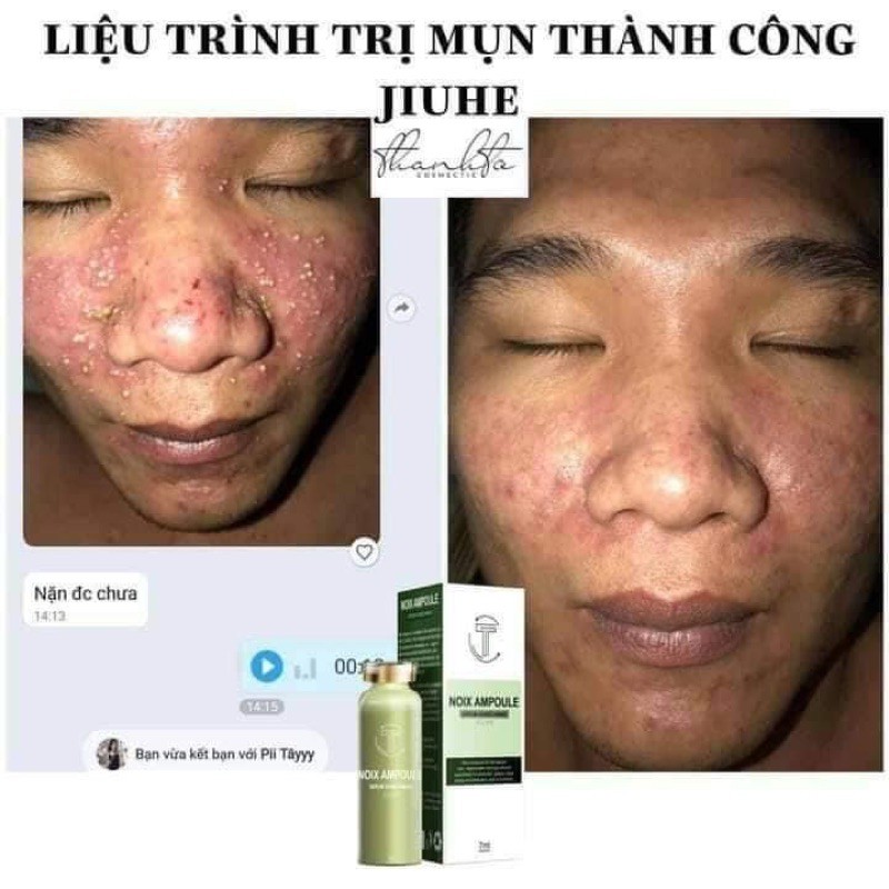 SERUM JIUHE ACNES NANO MỤN THANH TÔ CHÍNH HÃNG 100%