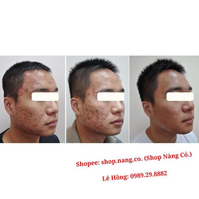 Kem Đông Y KEM MỤN Ngân Bình > Hết mụn thâm sẹo, mụn bọc mủ, mụn ẩn, mụn đầu đen > KEM XÓA MỤN ĐÔNG Y NGÂN BÌNH