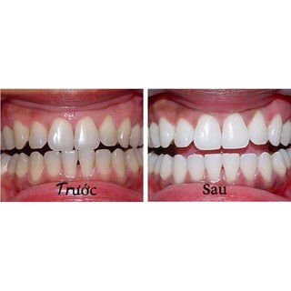 1 Miếng dán trắng răng Crest 3D White Supreme FlexFit