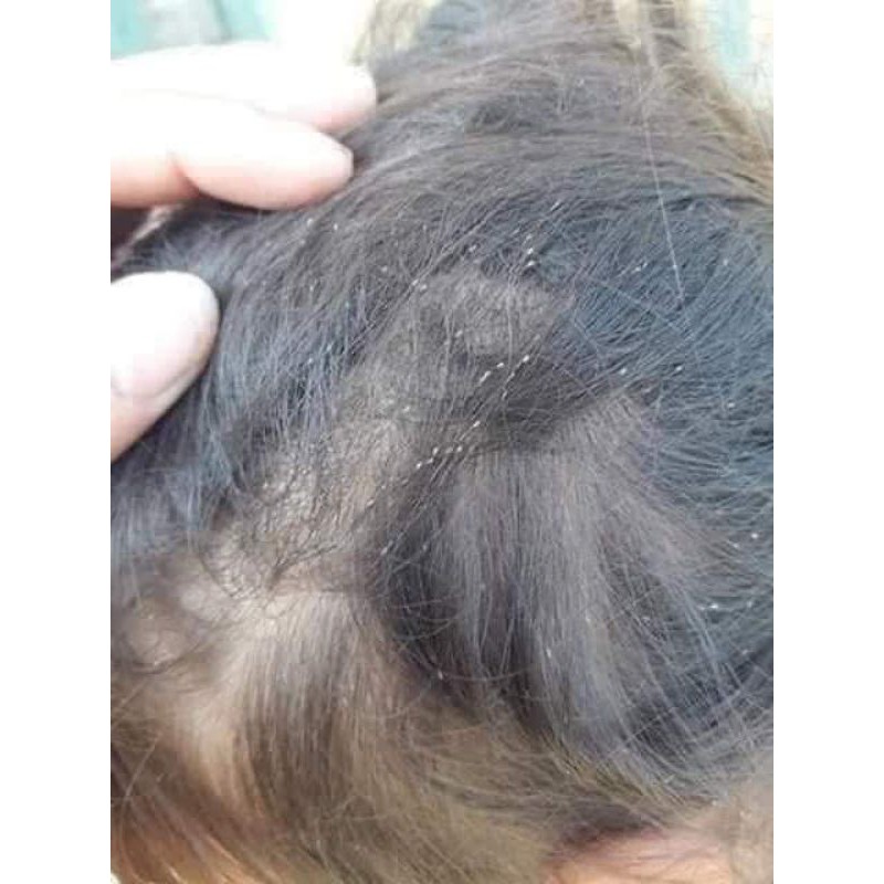 DẦU GỘI GIẢM CHẤY ( CHÍ ) ANTI - LICE THÁI LAN