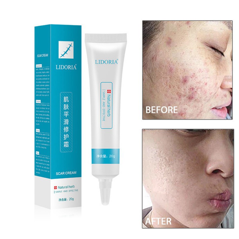 [Hàng mới về] Kem chăm sóc da mặt LIDUOLIYA 20g hydrat hóa loại bỏ sẹo mụn cho da mịn màng | BigBuy360 - bigbuy360.vn
