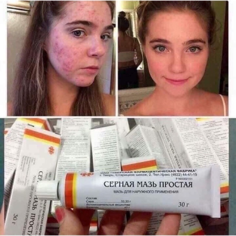 Kem chuyên mụn bọc, trứng cá lưu huỳnh Cephar Nga