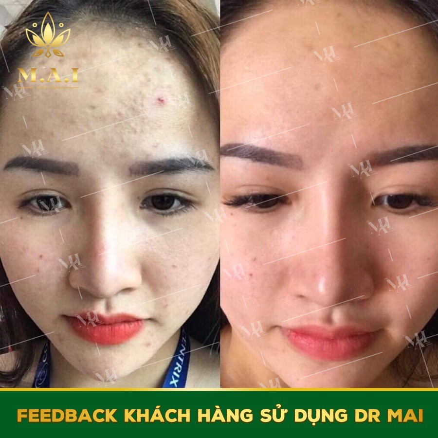 Dr mai [CHÍNH HÃNG] - sạch mụn xoá thâm - hiệu quả sau 7 ngày | BigBuy360 - bigbuy360.vn