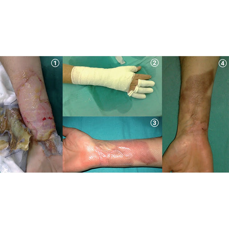 Tấm lưới silicone bảo vệ vết thương Mepitel One