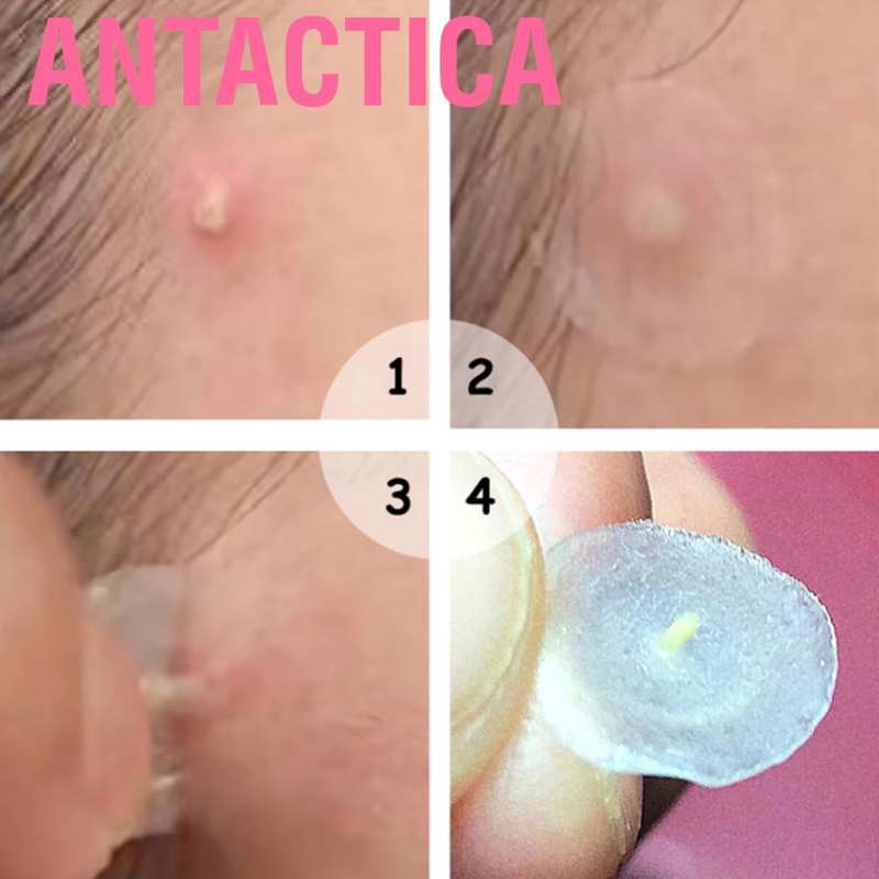 Set 36 Miếng Dán Che Mụn Chống Thấm Nước Thoáng Khí | BigBuy360 - bigbuy360.vn