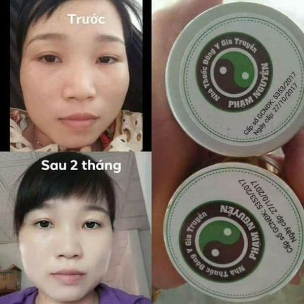 Dưỡng da giảm mụn, xoá nám tàn nhang 1T