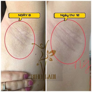 Siêu Dưỡng Thâm 5S