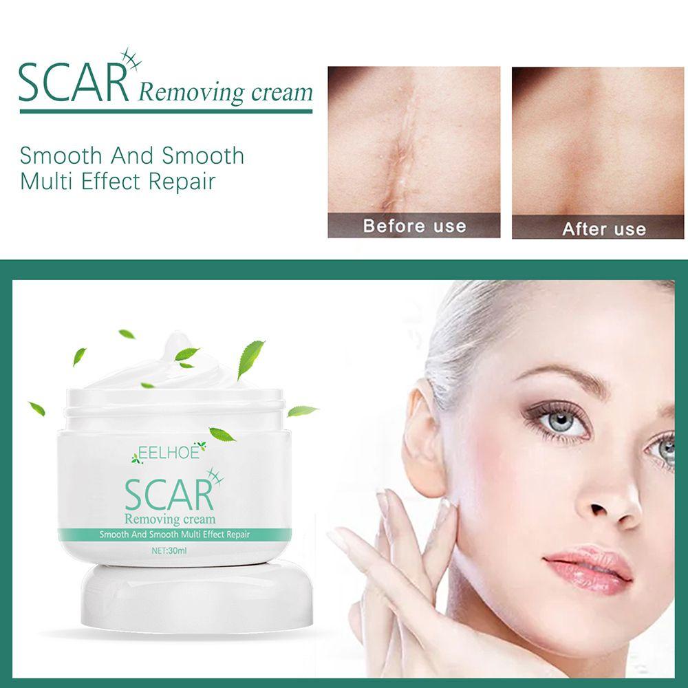 Kem Hỗ trợ giảm sẹo XIANTIN Chất Lượng Cao Tiện Dụng