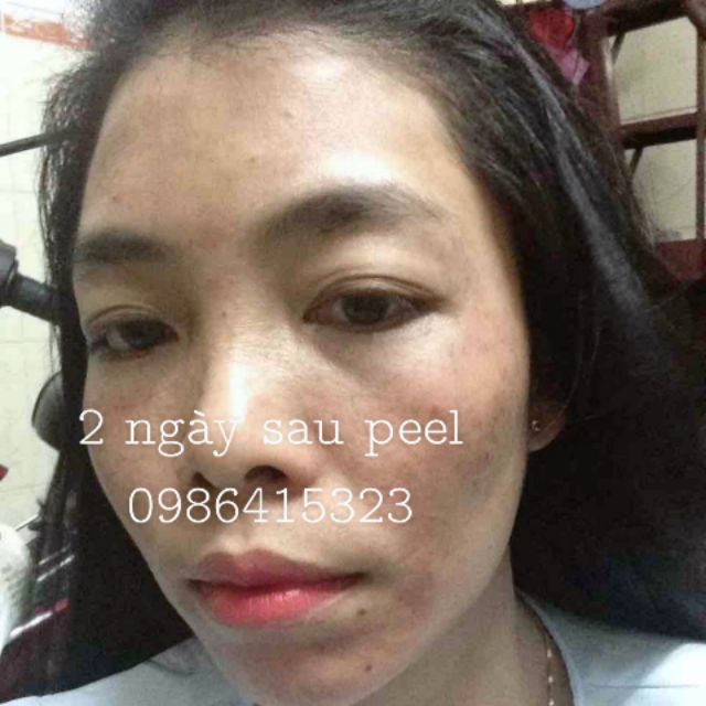 THAY DA MẶT TCA_USA - PEEL SKIN TCA TRỊ NÁM. RỔ. SẸO. TÀN NHANG. THÂM MỤN.MỤN ẨN. Bọc