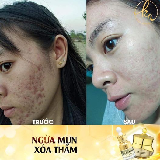 Combo face Kn Beauty serum – Kem dưỡng trắng Ngừa Mụn TẶNG NGAY DẦU GỘI THẢO DƯỢC