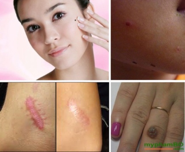 Gel tẩy nốt ruồi mụn cóc mụn thịt sẹo lồi Dvelinil Của Nga Sena Beauty | BigBuy360 - bigbuy360.vn