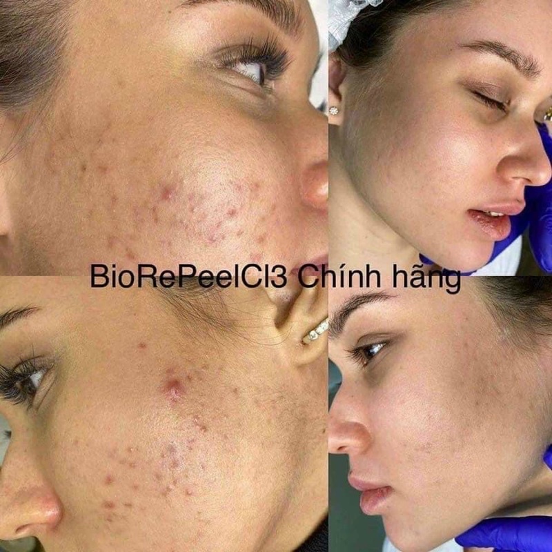 Tách lẻ 1 ống peel BioRepeelCL3 ( Hàng chính hãng )