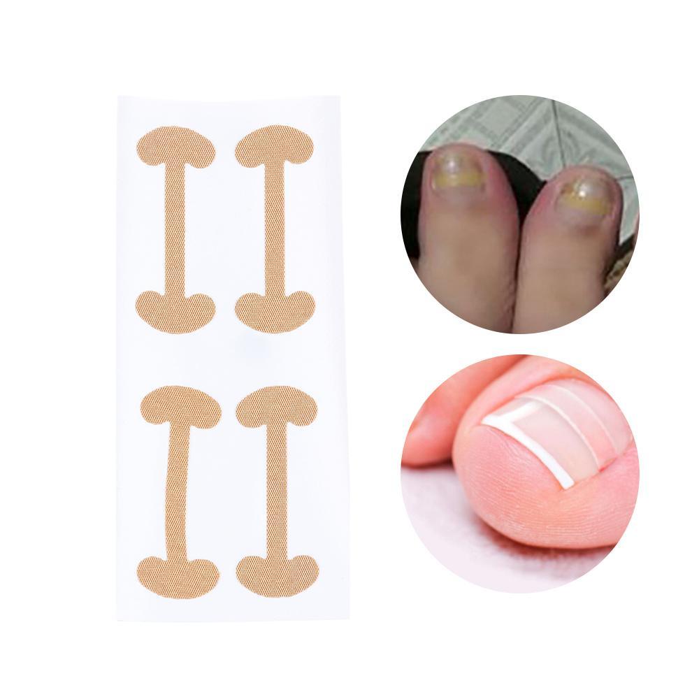 Miếng Dán Điều Chỉnh Móng Chân Chăm Sóc Sức Khỏe