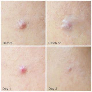 🐝🐝MIẾNG DÁN MỤN OLIVE YOUNG MẬT ONG 🐝🐝