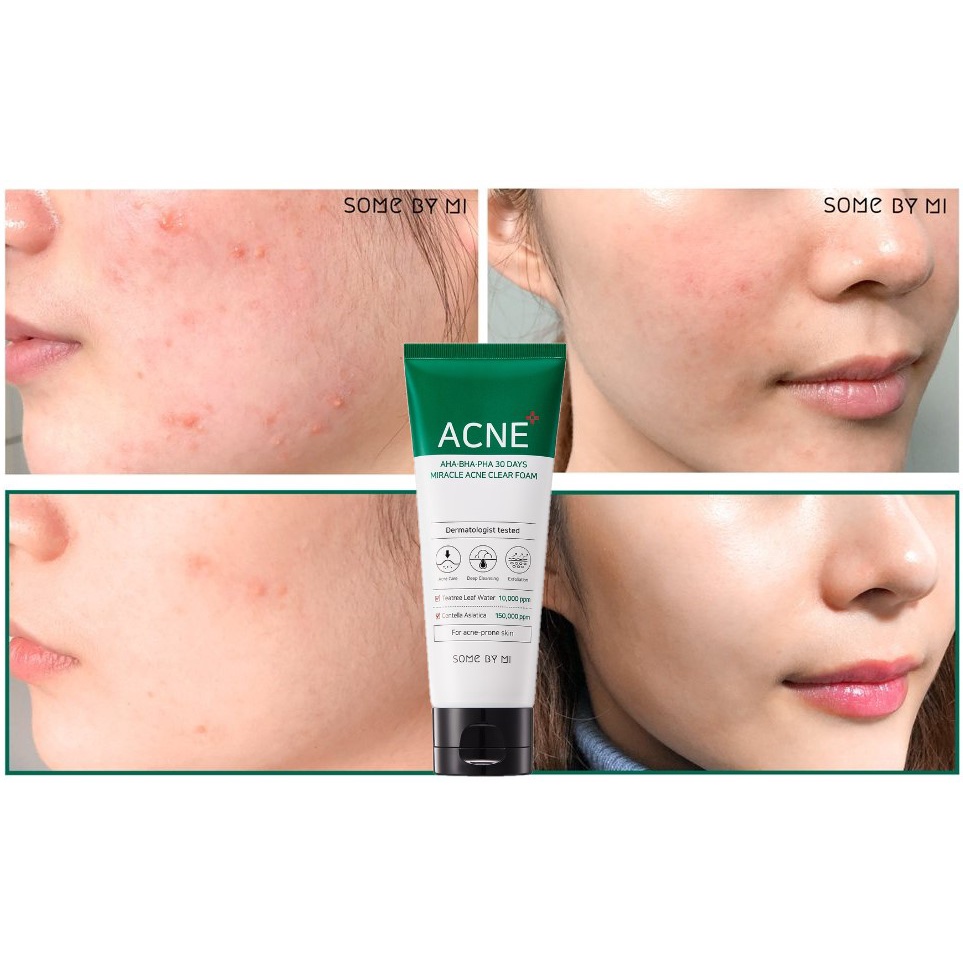 Sữa Rửa Mặt Làm Giảm, Ngăn Ngừa Mụn Some By Mi AHA BHA PHA 30 Days Miracle ACNE Clear Foam 100ml