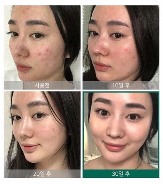 Serum ngăn ngừa Mụn Some By Mi AHA BHA PHA 30 Days Miracle
