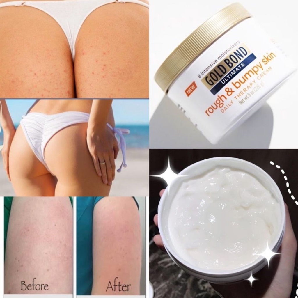Kem dưỡng thể ban đêm Gold Bond Ultimate Rough &amp; Bumpy Skin Daily Therapy Cream