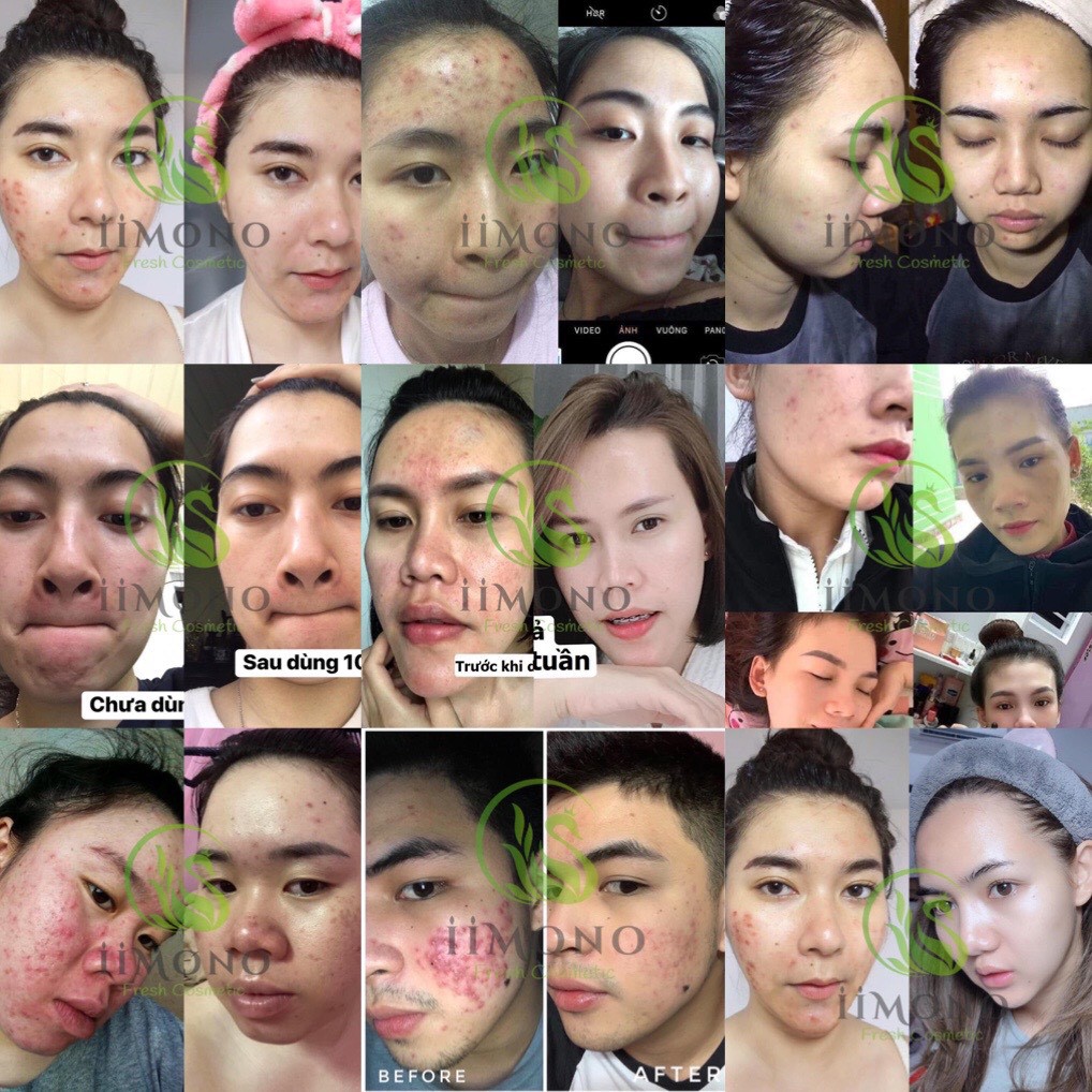 Giảm thâm mụn, bộ sản phẩm giảm mụn tinh chất thiên nhiên IIMONO | BigBuy360 - bigbuy360.vn