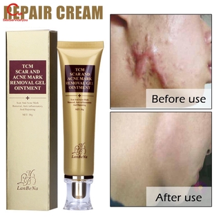 Scar Removal Cream Acne Removal Treatment Stretch Mark Scar Ointment 30g