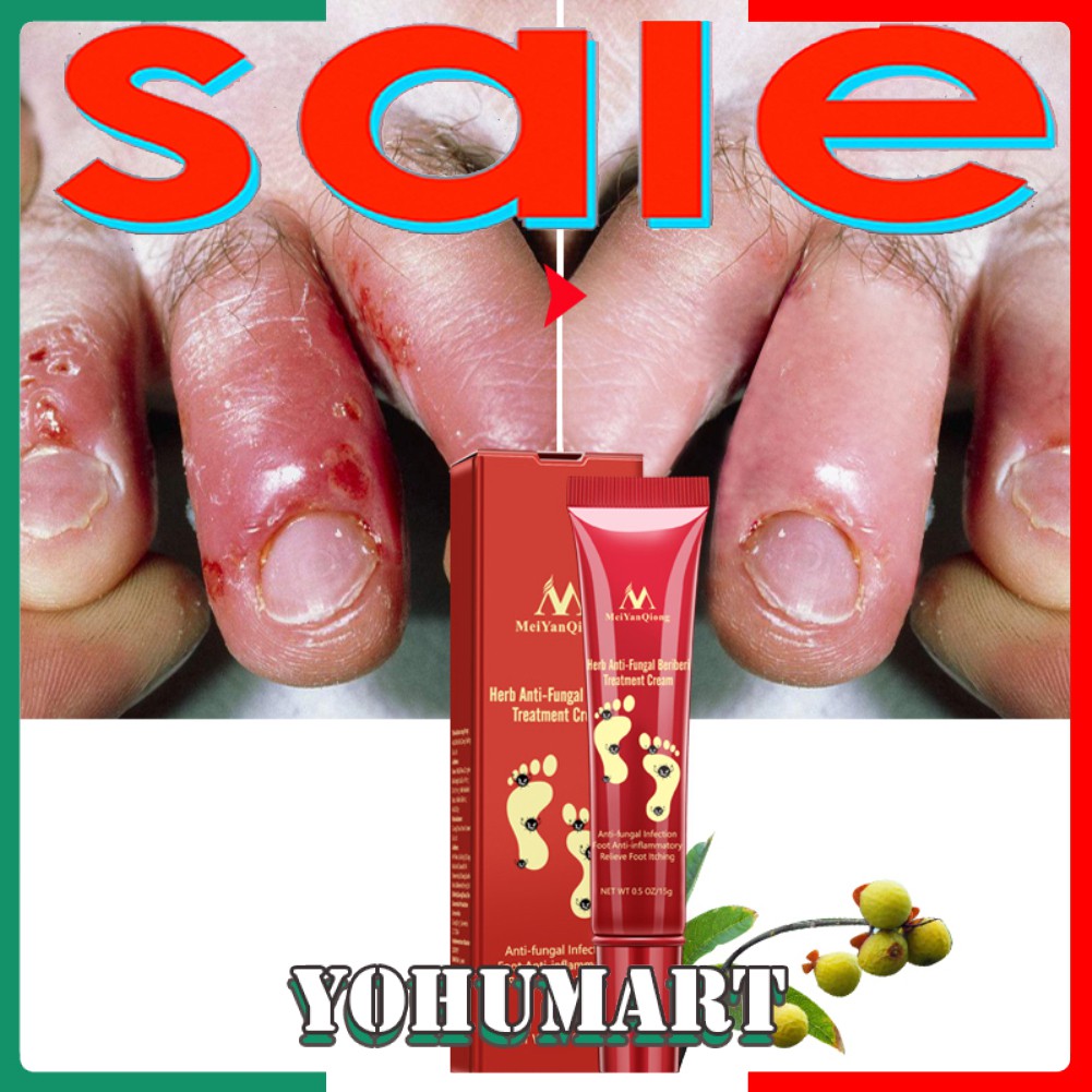 Thuốc mỡ hỗ trợ giảm bệnh nấm móng chân và ngứa
