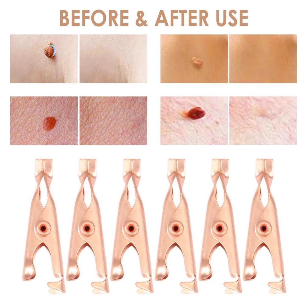 Bộ 2 Dụng Cụ Kẹp Loại Bỏ Thẻ Trên Da / Thẻ Xăm Nhỏ Bằng Đồng