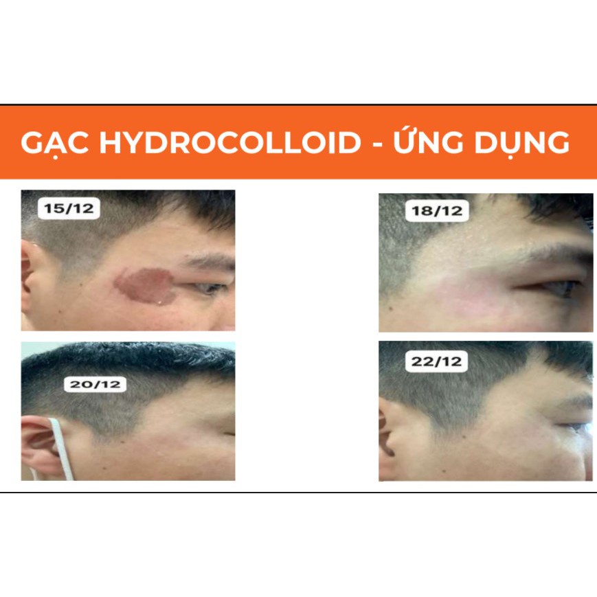 Miếng Dán Mụn - Vết Thương, vết bỏng HETIS Hydrocolloid R (10x10cm) [1 MIẾNG]