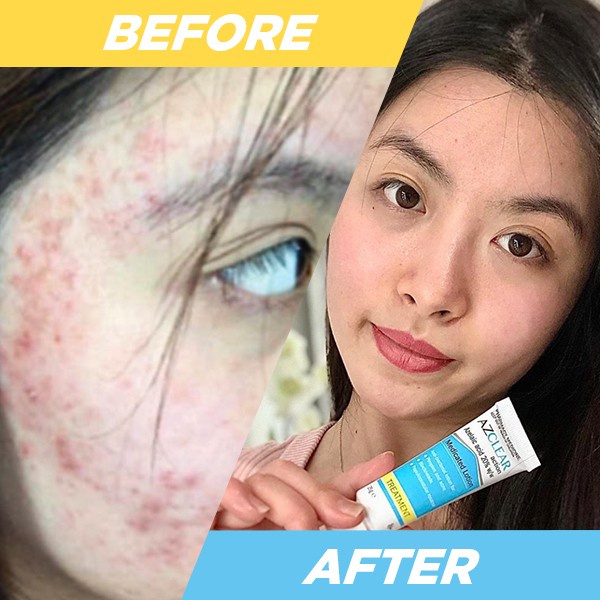 Kem giảm Mụn Azclear Medicated Lotion 25g Úc giảm mụn sưng mờ nám tàn nhan hiệu quả nhất hiện nay