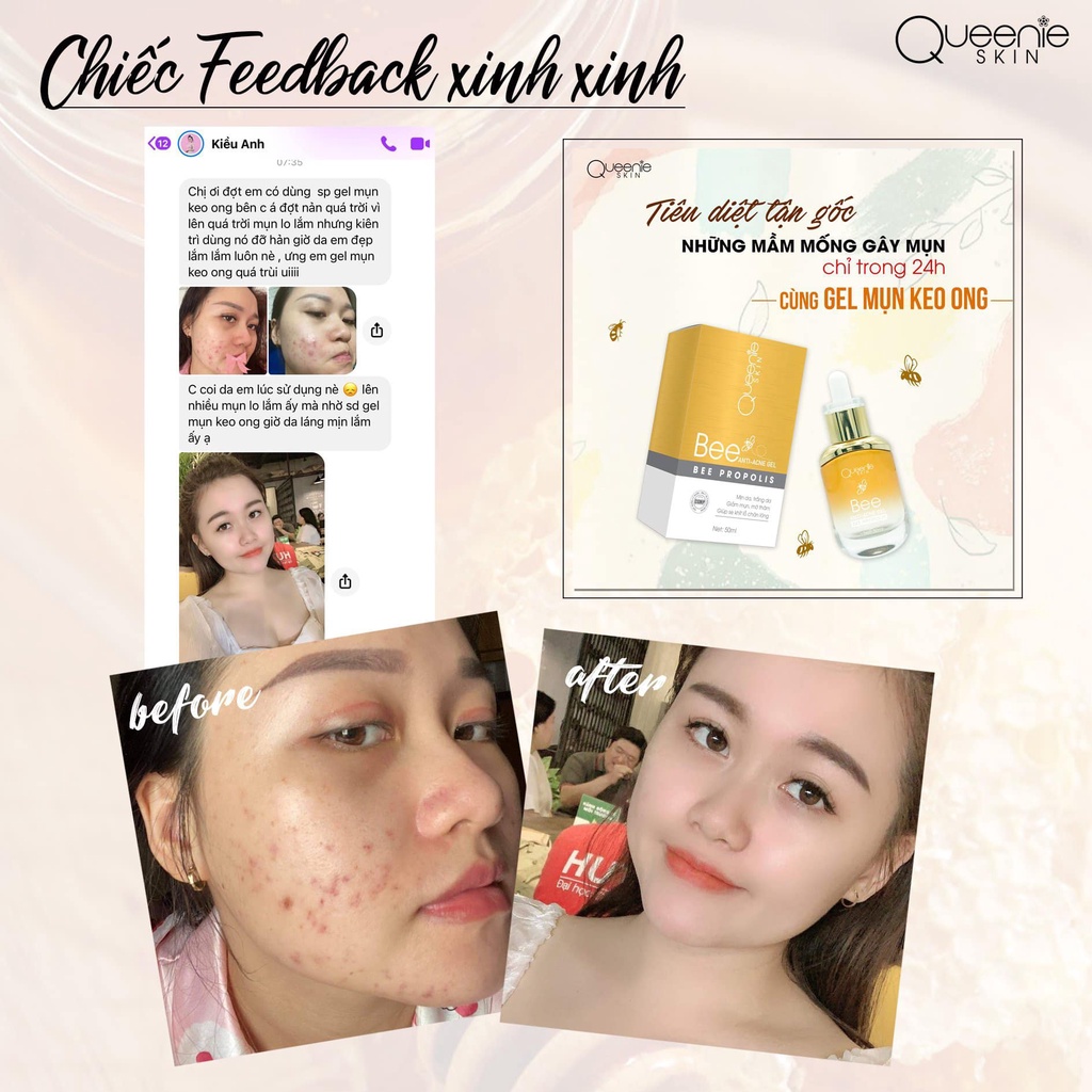 [FreeShip + Tặng Quà] Gel Mụn Keo Ong Queenie Skin Date Mới Nhất - Gel Mụn Queenie Skin Date 2023