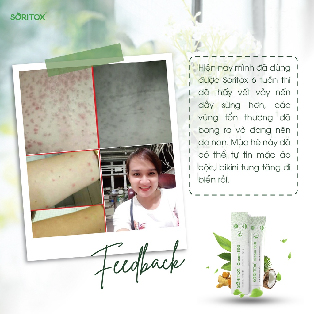 Kem bôi Vảy nến, Viêm da cơ địa, Chàm da, Nấm da, Hắc lào, Á sừng, Tiết bã, Chàm sữa, Dưỡng ẩm da - SORITOX CREAM 50GR