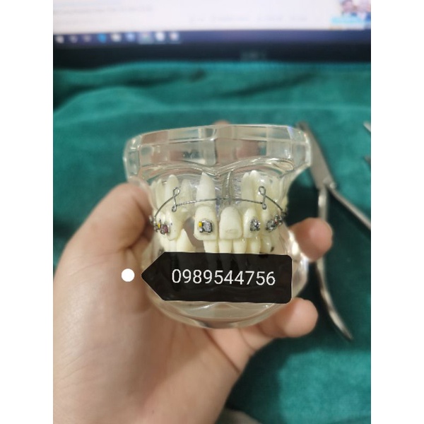 Cung ricketts Bio, cung đánh lún và kéo lui nhóm răng cửa